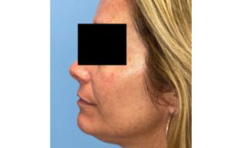 Before and after: Sofwave