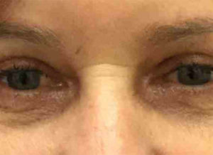 Blepharoplasty Before and After Pictures Bucks County, PA and Hunterdon County, NJ