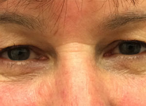 Blepharoplasty Before and After Pictures Bucks County, PA and Hunterdon County, NJ