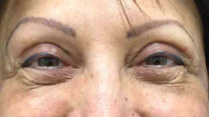 Blepharoplasty Before and After Pictures Bucks County, PA