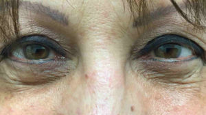 Blepharoplasty Before and After Pictures Bucks County, PA