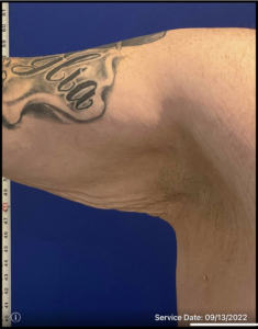 Arm Lift (Brachioplasty) Before and After Pictures Bucks County, PA and Hunterdon County, NJ