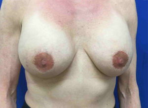 Breast Augmentation Before and After Pictures Bucks County, PA and Hunterdon County, NJ