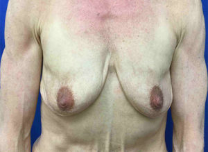 Breast Augmentation Before and After Pictures Bucks County, PA and Hunterdon County, NJ