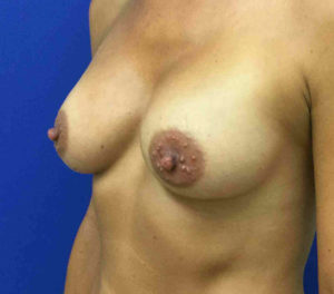 Breast Augmentation Before and After Pictures Bucks County, PA and Hunterdon County, NJ