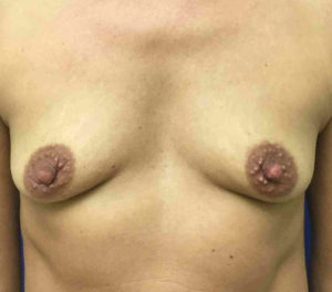 Breast Augmentation Before and After Pictures in Bucks County, PA, and Hunterdon County, NJ