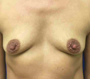 Breast Augmentation Before and After Pictures Bucks County, PA and Hunterdon County, NJ