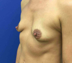 Breast Augmentation Before and After Pictures Bucks County, PA and Hunterdon County, NJ