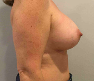 Breast Augmentation Before and After Pictures Bucks County, PA and Hunterdon County, NJ