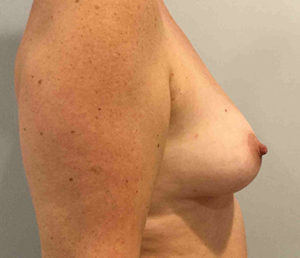 Breast Augmentation Before and After Pictures in Bucks County, PA, and Hunterdon County, NJ