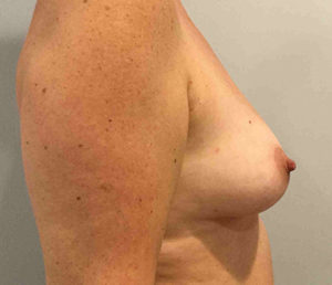 Breast Augmentation Before and After Pictures Bucks County, PA and Hunterdon County, NJ