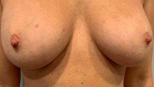 Breast Implant Removal Before and After