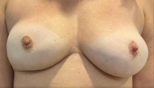 Breast Implant Removal Before and After Pictures Bucks County, PA and Hunterdon County, NJ
