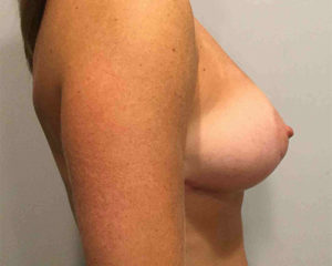Breast-Lift-Case-1-Side-After-300x240 Breast Lift Before and After in Bucks County, PA, and Hunterdon County, NJ