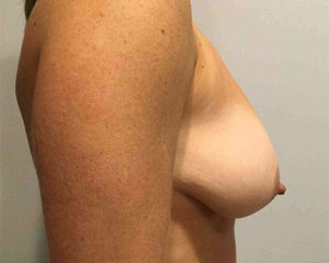 Breast-Lift-Case-1-Side-Before-300x240 Breast Lift Before and After in Bucks County, PA, and Hunterdon County, NJ