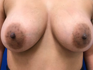 Breast Lift Before and After Pictures Bucks County, PA and Hunterdon County, NJ