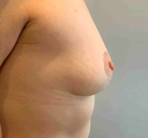 Breast Lift Before and After Pictures Bucks County, PA and Hunterdon County, NJ