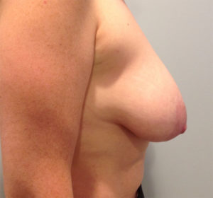 Breast Lift Before and After in Bucks County, PA, and Hunterdon County, NJ