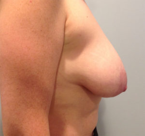 Breast Lift Before and After Pictures Bucks County, PA and Hunterdon County, NJ