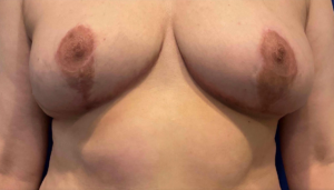 Breast Lift Before and After Pictures Bucks County, PA and Hunterdon County, NJ