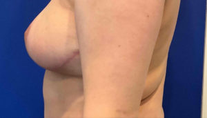 Breast-Lift-Case-5-Left-After-300x171 Breast Lift Before and After in Bucks County, PA, and Hunterdon County, NJ