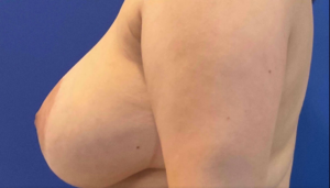 Breast-Lift-Case-5-Left-Before-300x171 Breast Lift Before and After in Bucks County, PA, and Hunterdon County, NJ