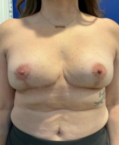 Breast Lift Before and After Pictures Bucks County, PA and Hunterdon County, NJ