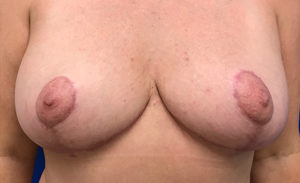 Breast Lift Before and After Pictures Bucks County, PA and Hunterdon County, NJ