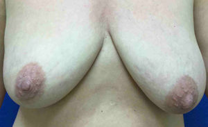 Breast Lift Before and After Pictures Bucks County, PA and Hunterdon County, NJ