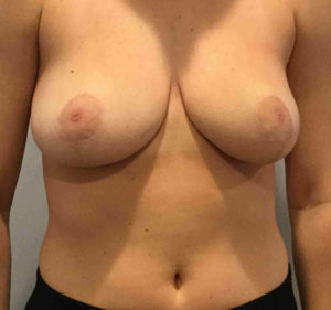 Breast Reduction Before and After Pictures Bucks County, PA and Hunterdon County, NJ