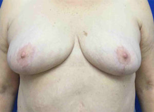 Breast Reduction Before and After Pictures in Bucks County, PA, and Hunterdon County, NJ
