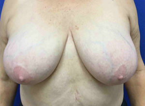 Breast Reduction Before and After Pictures Bucks County, PA and Hunterdon County, NJ