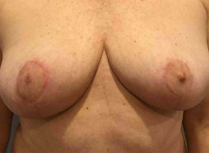 Breast Reduction Before and After Pictures Bucks County, PA and Hunterdon County, NJ