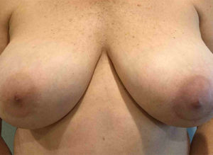 Breast Reduction Before and After Pictures Bucks County, PA