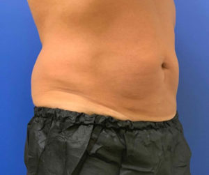 Coolsculpting Before and After Pictures Bucks County, PA and Hunterdon County, NJ