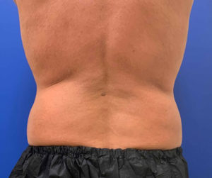 Coolsculpting Before and After Pictures Bucks County, PA and Hunterdon County, NJ