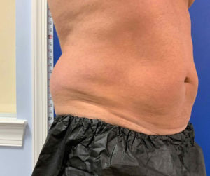 Coolsculpting Before and After Pictures Bucks County, PA and Hunterdon County, NJ