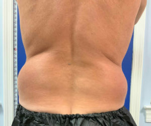 Coolsculpting Before and After Pictures Bucks County, PA and Hunterdon County, NJ