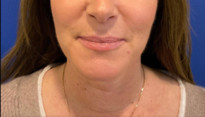 Dermal Fillers and Injectables Before and After Pictures Bucks County, PA and Hunterdon County, NJ