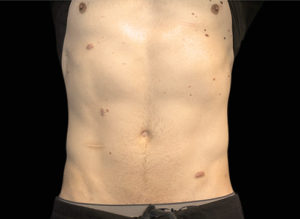 EMSCULPT Before and After Pictures Bucks County, PA and Hunterdon County, NJ