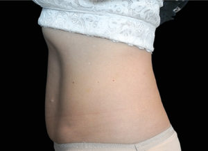 EMSCULPT Before and After Pictures Bucks County, PA and Hunterdon County, NJ