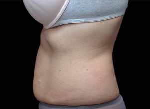 EMSCULPT Before and After Pictures Bucks County, PA and Hunterdon County, NJ