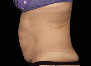 EMSCULPT Before and After Pictures Bucks County, PA and Hunterdon County, NJ