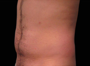 EMSCULPT Before and After Pictures Bucks County, PA and Hunterdon County, NJ