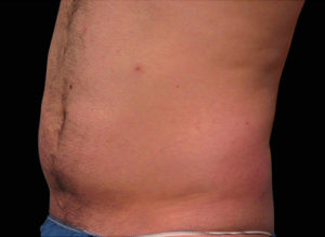 EMSCULPT Before and After Pictures Bucks County, PA and Hunterdon County, NJ