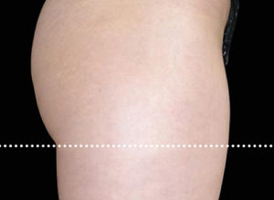 EMSCULPT Before and After Pictures Bucks County, PA and Hunterdon County, NJ
