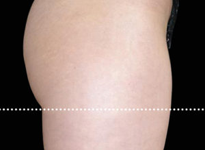 EMSCULPT Before and After Pictures Bucks County, PA and Hunterdon County, NJ