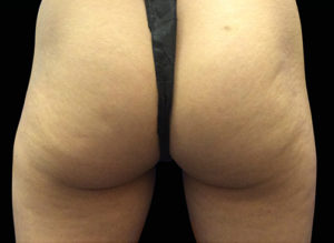 EMSCULPT Before and After Pictures Bucks County, PA and Hunterdon County, NJ