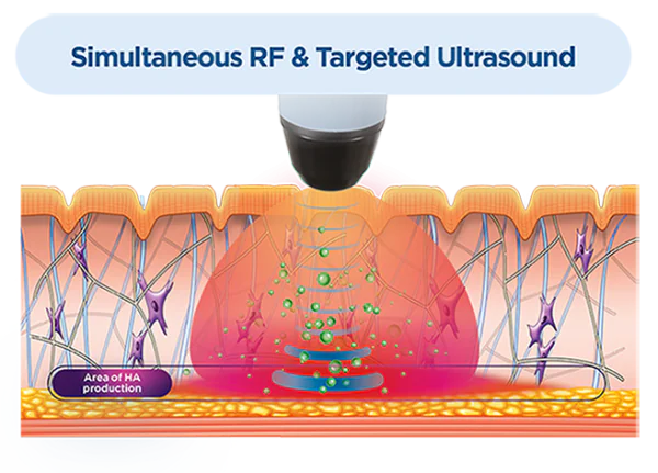 Illustrated diagram of Exion's simultaneous RF and targeted ultrasound treatment
