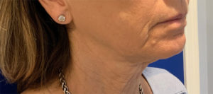 Facelift Before and After Pictures Bucks County, PA and Hunterdon County, NJ